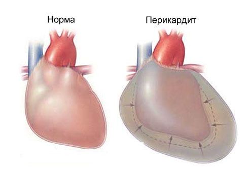 Acute pericarditis en pijn op de borst aan de linkerkant