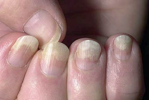 Peeling van de nagelplaat van zachte weefsels