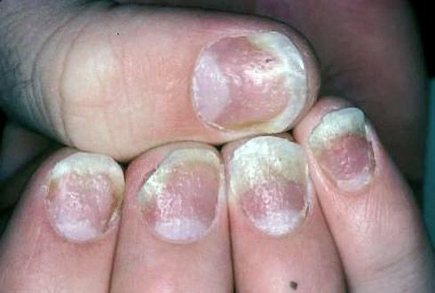 Gaten en inkepingen op het oppervlak van de nagel