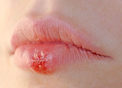 Waarom herpes "opduikt"