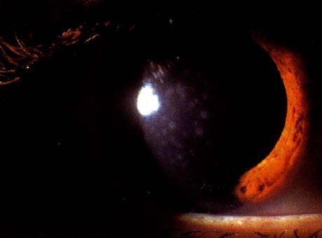 Epidemische keratoconjunctivitis