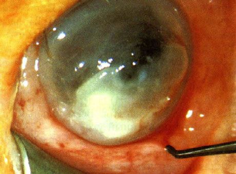 Keratitis veroorzaakt door Pseudomonas bij een pasgeborene.  Predisponerende factoren zijn niet geïdentificeerd