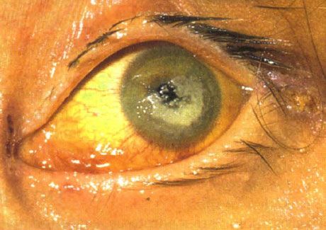 Bilaterale keratitis veroorzaakt door Candida bij een kind met ernstige immunodeficiëntie