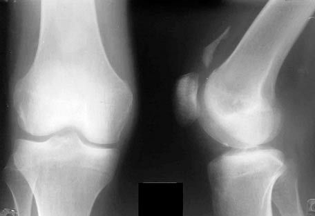 Röntgen van het kniegewricht