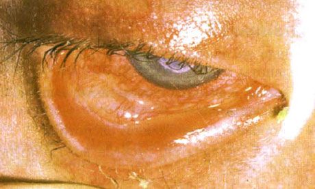Syndroom Stevens-Johnson.  Dubbelzijdige desquamative conjunctivitis met gebieden van necrose.  Zware keratitis, waardoor littekens op het hoornvlies ontstonden.  De situatie werd gecompliceerd door de toevoeging van het syndroom van "droge" ogen