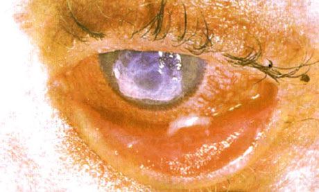 Syndroom Stevens-Johnson.  Dubbelzijdige desquamative conjunctivitis met gebieden van necrose.  Zware keratitis, waardoor littekens op het hoornvlies ontstonden.  De situatie werd gecompliceerd door de toevoeging van het syndroom van "droge" ogen