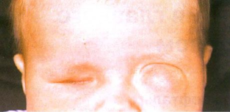 Microftalmie met bijbehorende cystevorming (linkeroog). Anoftalmie (rechteroog).