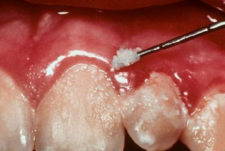 Tanden en gingivitis