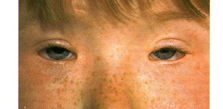 Blefarofimosesyndroom. Bilaterale geopereerde ptosis, telecanthus en blefarofimose.