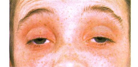 Externe oftalmoplegie. Bilaterale ptosis. De patiënt opent de ogen door de wenkbrauwen op te trekken.