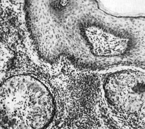 Ziekteverwekkers chromoblastomycosis